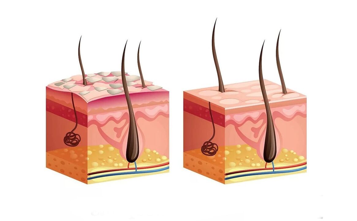 Koža z luskavico pred in po nanosu kreme