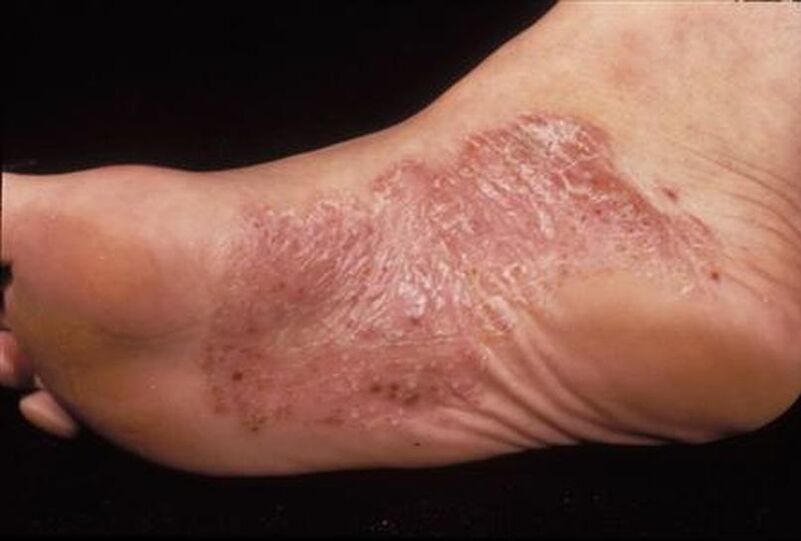simptomi luskavice na stopalih