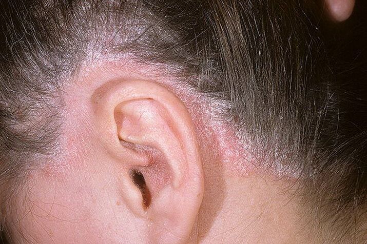 Izbruhi luskavice na glavi za ušesi
