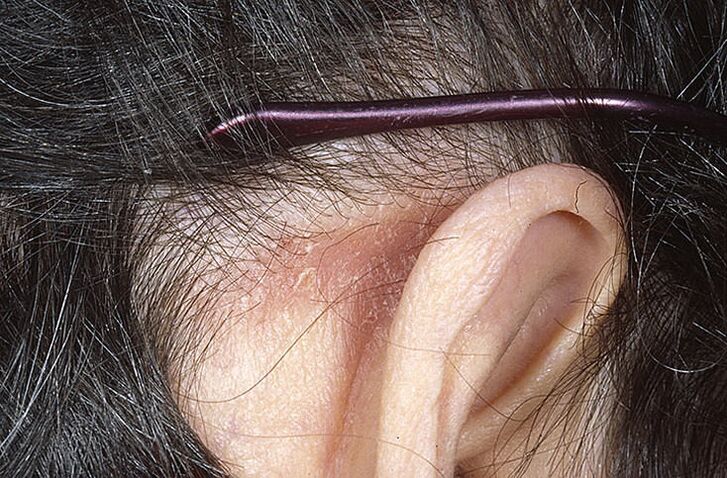 Psoriatični plak za ušesom