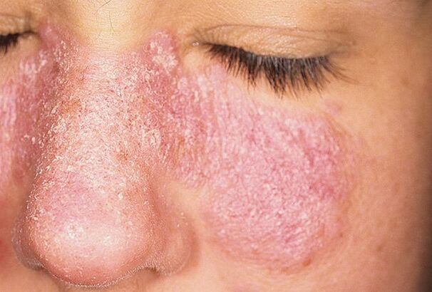 Progresivna stopnja psoriaze na koži obraza