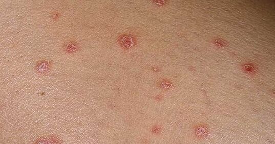 Psoriatične plakete