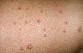 Psoriatične plakete