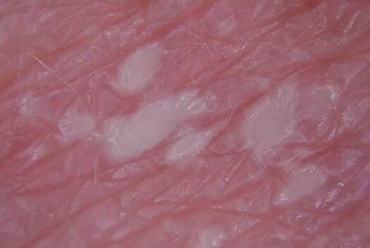 Pustulenia psoriaza