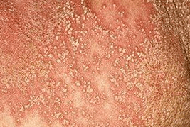 Pustularna psoriaza