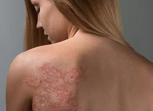 Psoriaza na hrbtu dekleta