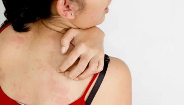 psoriaza