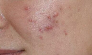 simptomi začetne stopnje psoriaze