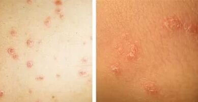 glavne manifestacije psoriaze