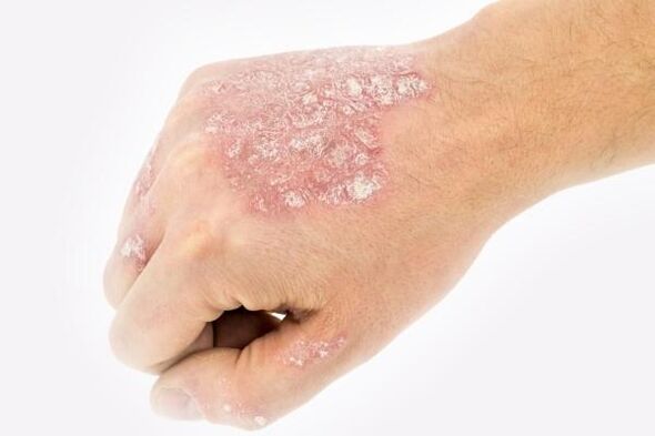 mehanizem razvoja psoriaze na rokah