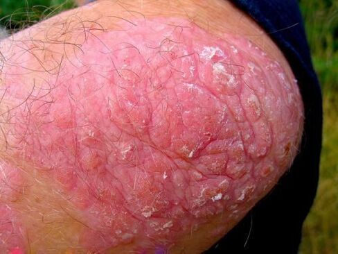 psoriaza vulgaris na kolenu