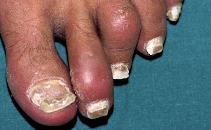 Luskavica z vpletenostjo nohtov in vnetjem sklepov (artritis) prstov na nogah