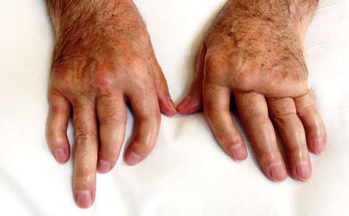 Pohabljajoči artritis pri luskavici